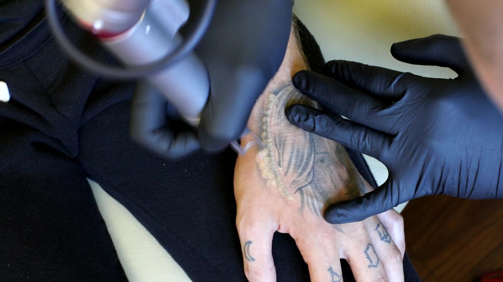 Tattoo Laser Treatments